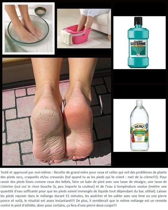 astuce pour les pieds abimés